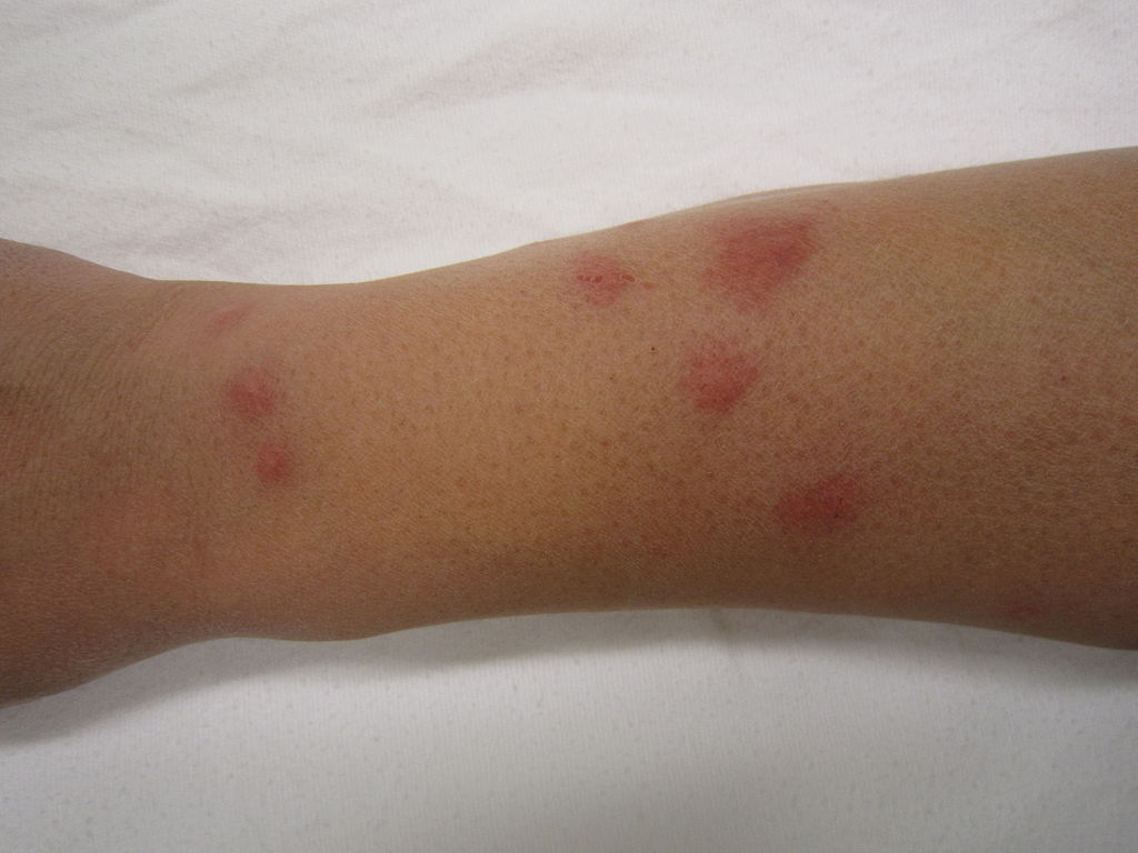 Pinches on the forearm from bedbugs at home